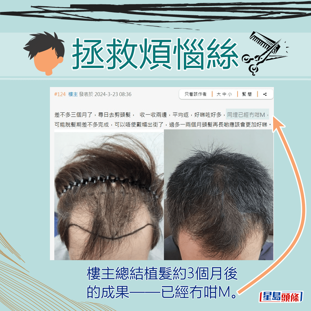 樓主總結植髮約3個月後的成果——已經冇咁M。「香港討論區」截圖