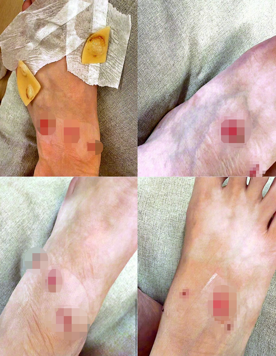 徐小姐的脚有多处损伤。《新闻晨报》