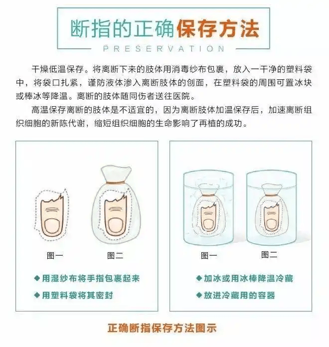 斷指正確保存法。 斷指正確保存法。