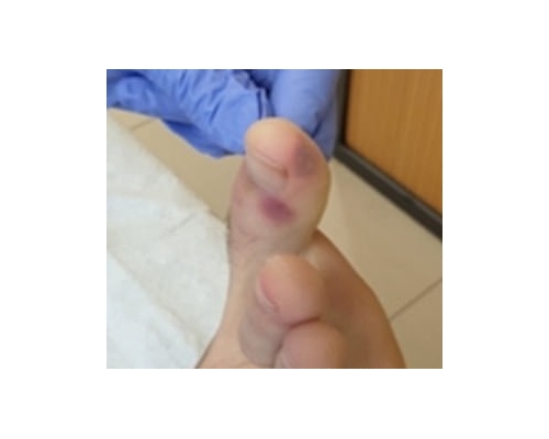 一些新冠肺炎患者的腳上出現了「類似水痘或麻疹」的病變。(網圖)