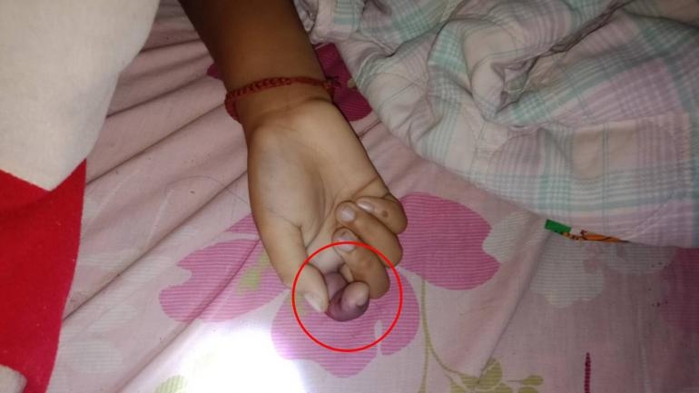 女童手指有類似被蛇咬過的瘀傷。(互聯網圖片)