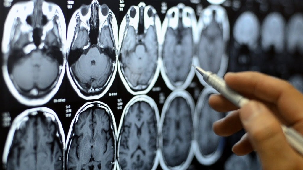 老人癡呆症又名失智症。路透社 老人癡呆症又名失智症。路透社