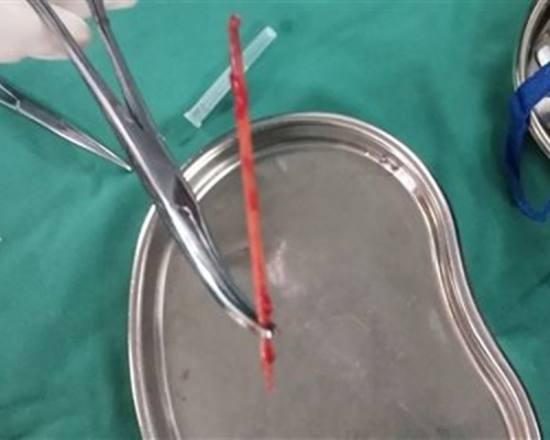 廣東男子腰腿痛半年，揭牙籤藏體內。網上圖片
