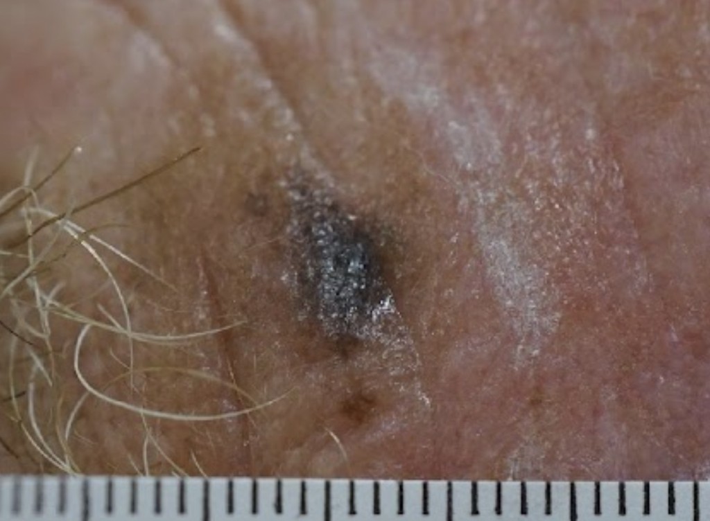 黑色素皮膚癌（圖片由受訪者提供）