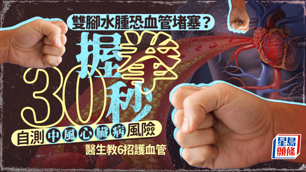 雙腳水腫恐血管堵塞？握拳30秒自測中風/心臟病風險 醫生教6招護血管