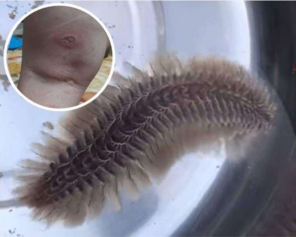 自去年起,有不少市民被海毛蟲所傷。(資料圖片)