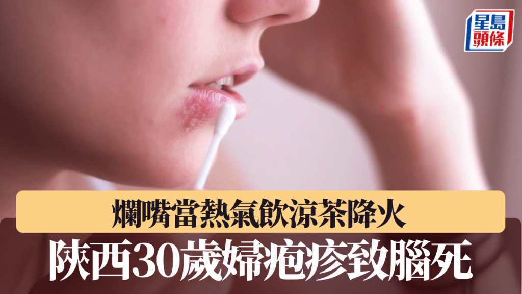 陝西有約30歲婦人，輕視疱疹導致的爛嘴，因延醫變腦死亡。iStock