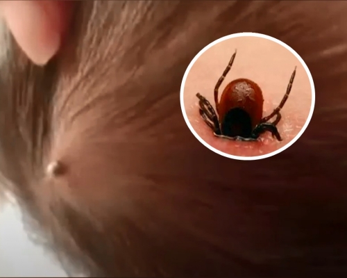 內地一名出生僅4天的嬰兒遭蜱蟲咬傷，4天後蜱蟲頭部已完全鑽入嬰孩頭部。短片截圖