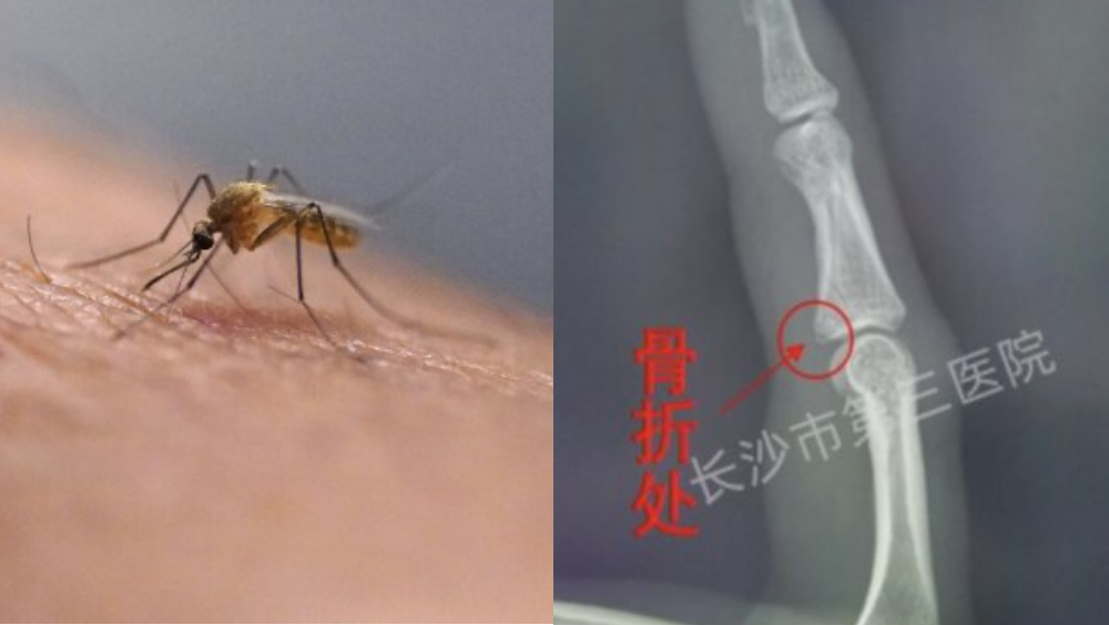 35歲湖南女拍蚊致手指骨折，右圖為就醫拍下的X光片。