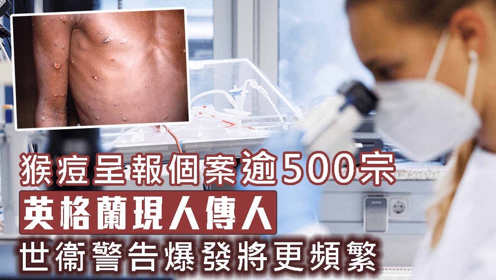 猴痘呈報個案逾500宗,英格蘭現人傳人。路透社圖片