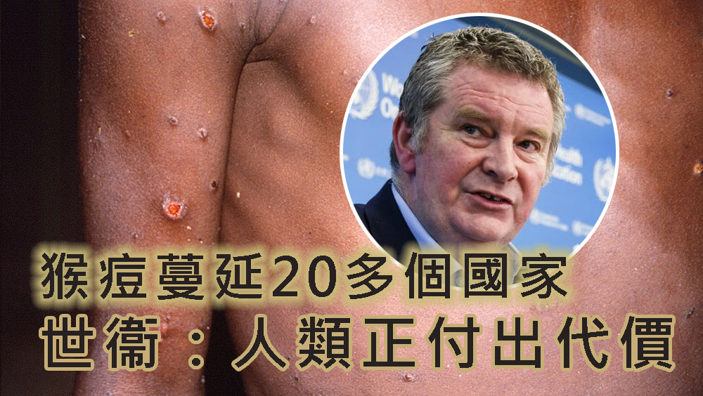 猴痘蔓延20多個國家,世衞表示人類正付出代價。AP