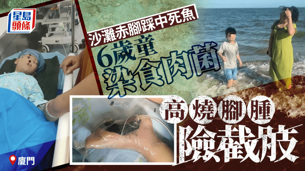 6歲男童沙灘赤腳踩到死魚被扎傷，高燒昏迷險截肢。抖音@路過的風景