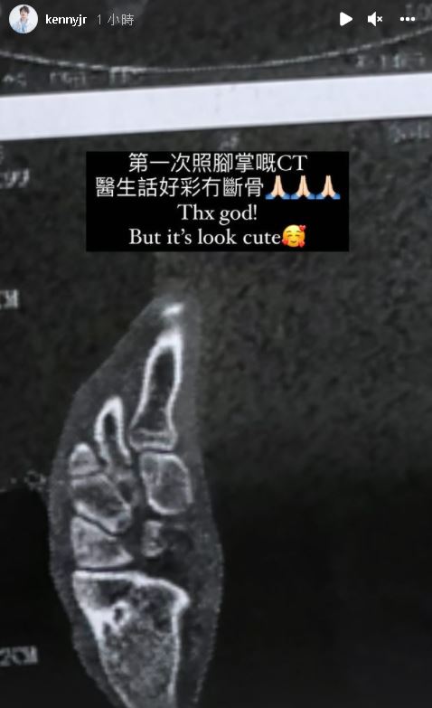照了X光,幸好沒有骨折。