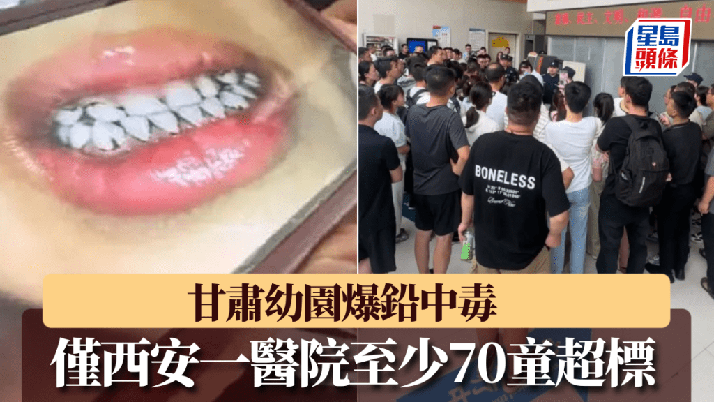 幼兒園血鉛中毒孩子牙黑成老煙民，家長湧西安一醫院檢測。