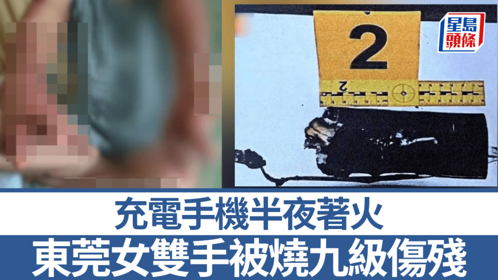 手機著火致陳小姐雙手嚴重燒傷。第一現場