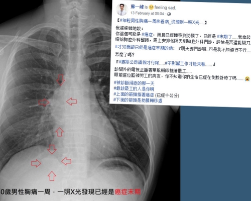 蘇一峰同時附上男病人的X光片，指對方已有一個10厘米腫瘤，並已轉移至肋膜。蘇一峰fb
