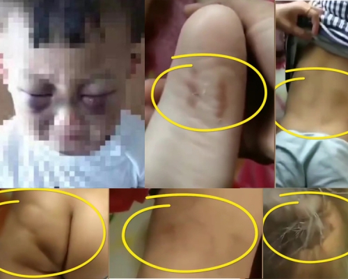山東一名3歲幼童慘遭後母虐待,全身是傷。(網圖)
