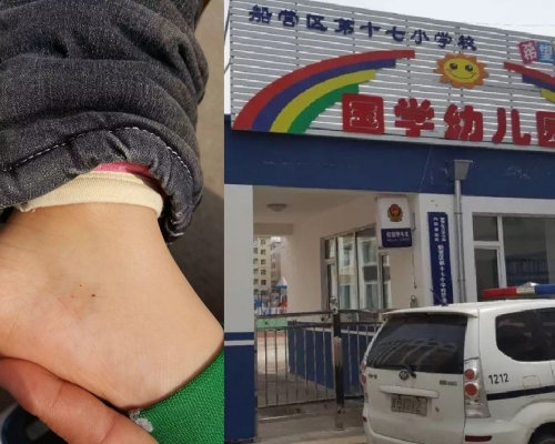 有學童腳裸被札。網圖