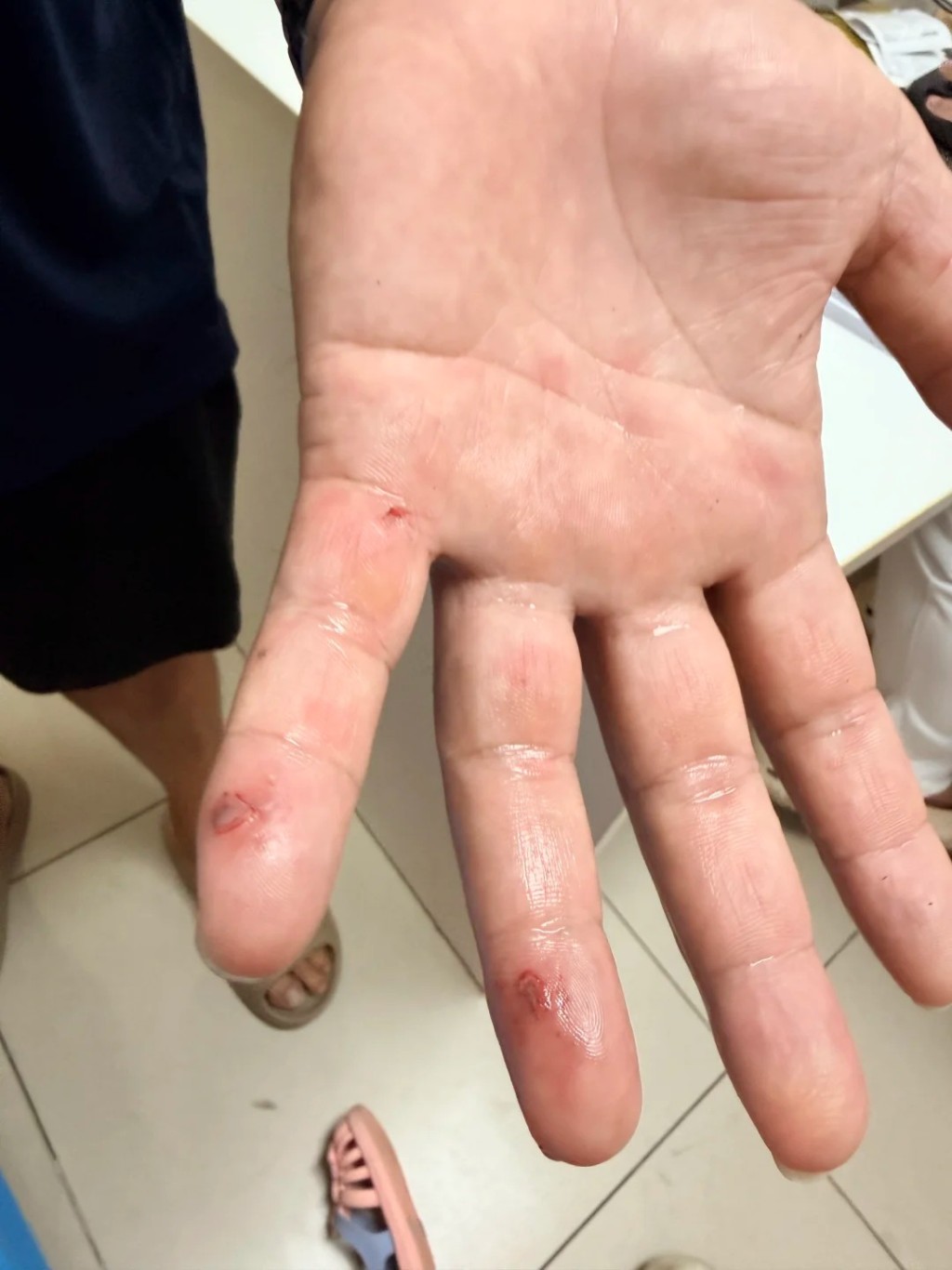 楊先生及女兒身體多處擦傷。 楊先生及女兒身體多處擦傷。