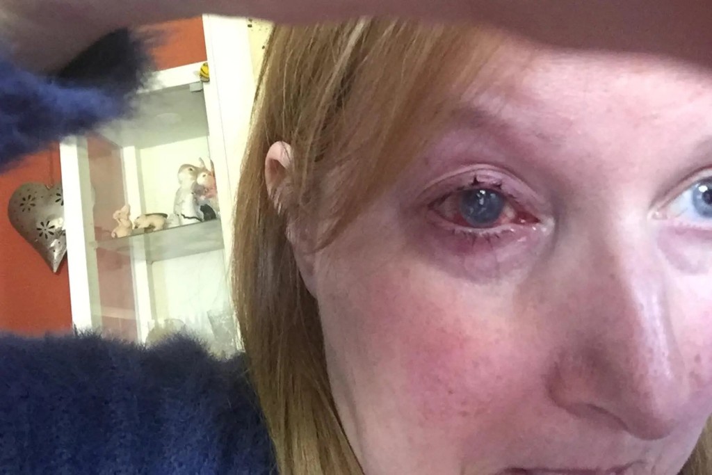 经医生诊断后，发现她的眼睛感染「棘阿米巴角膜炎」。网上图片