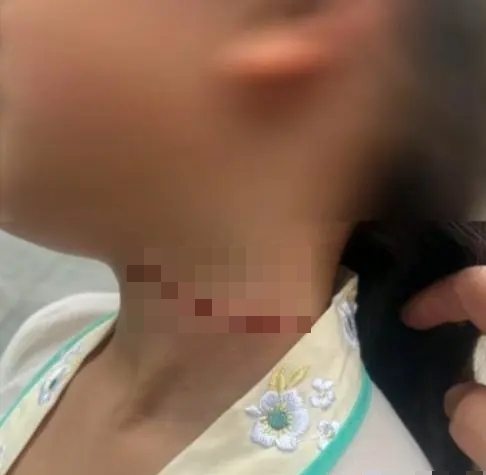 7岁女儿被风筝线割伤脖子，事后形成一条长长的红色蜈蚣疤。