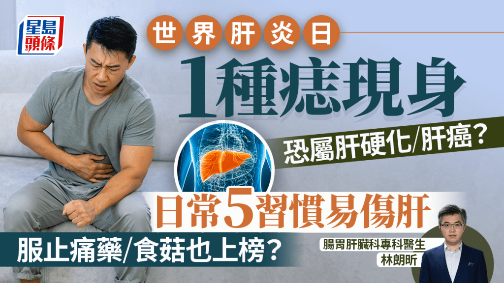 世界肝炎日|1種痣現身恐屬肝硬化/肝癌 醫生揭5大傷肝習慣 止痛藥勿亂食?
