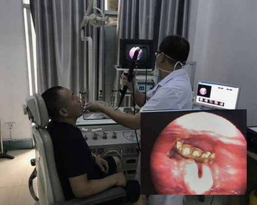 瓶蓋卡在男子氣管中。