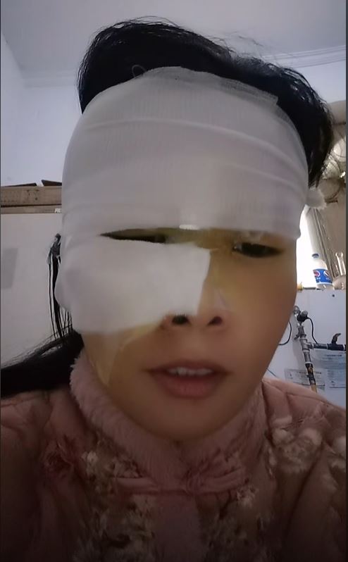 吳女士亂學網紅妙招除水垢，導致面部嚴重燙傷。抖音＠白醋加糖爆炸當事人