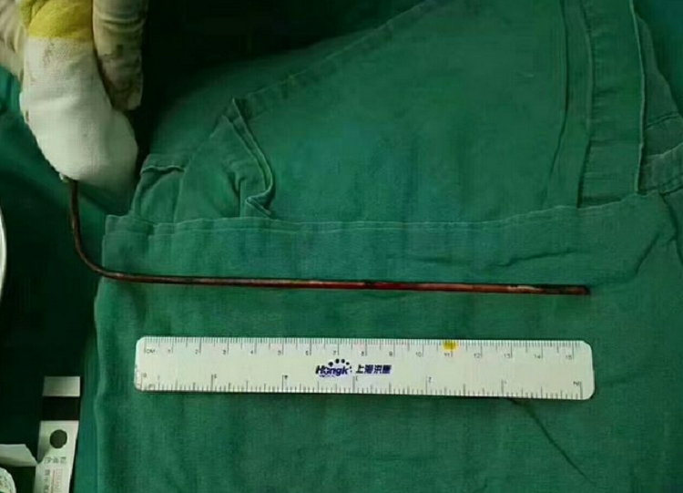 鋼筋貫穿男童的腦袋。網上圖片