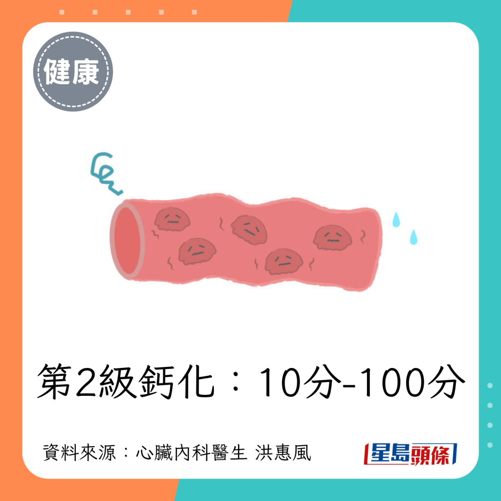 第2级钙化：10-100分