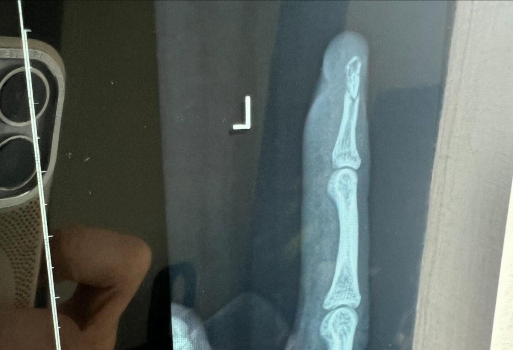 吳雲甫今日貼上手指受傷的相片。