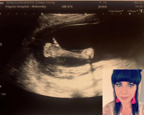 英國一名孕婦照B超驚見男嬰肚內豎大姆指。（網圖）