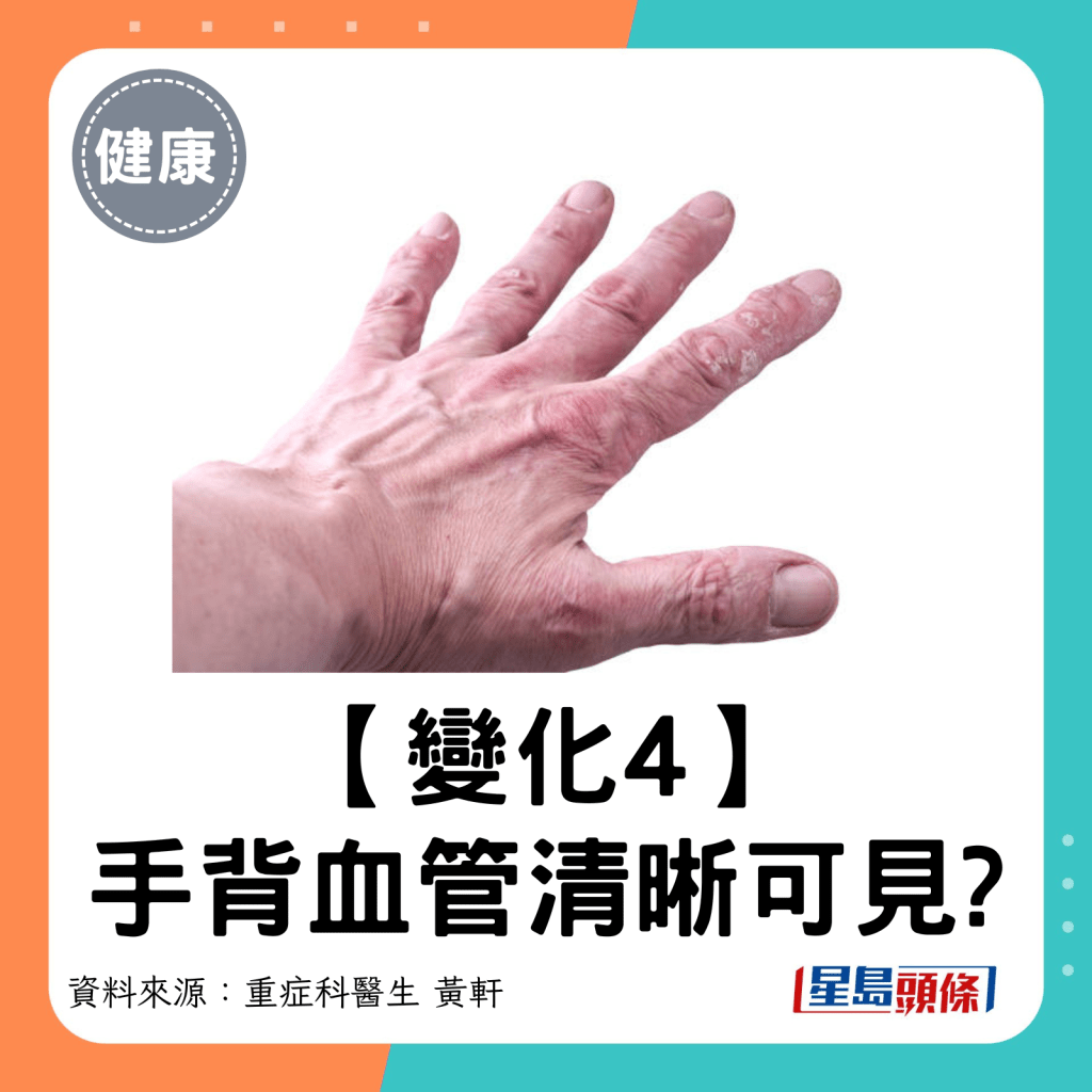 4. 手背血管清晰可见？