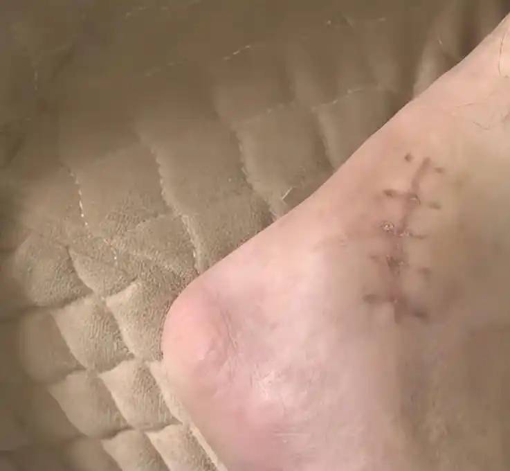 邱先生踝關節骨折。  都市現場