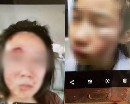 涉事男子的妻(左)女(右)均被打致滿臉傷痕。網圖