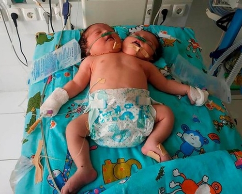 烏茲別克孕婦在21週產檢獲告知懷有畸胎，但被老爺禁止流產，結果誕下「雙頭嬰」。(網圖)