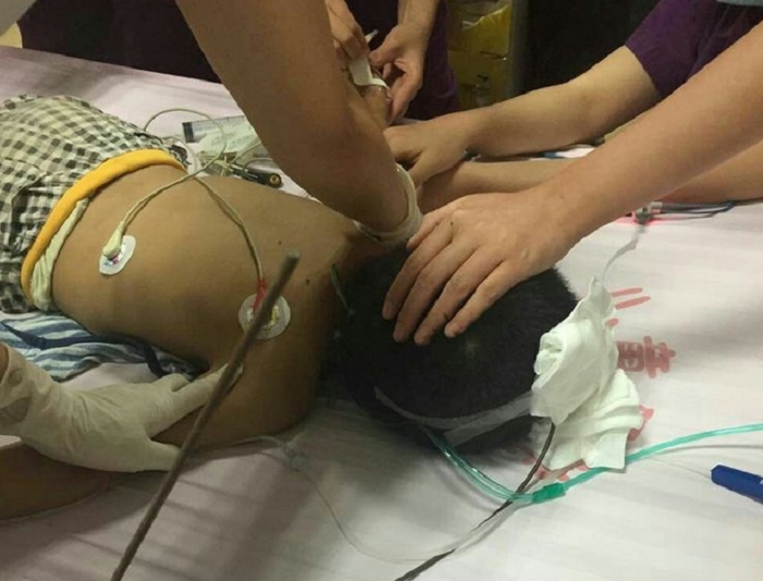 醫生取出貫穿男童腦袋的鋼筋。網上圖片