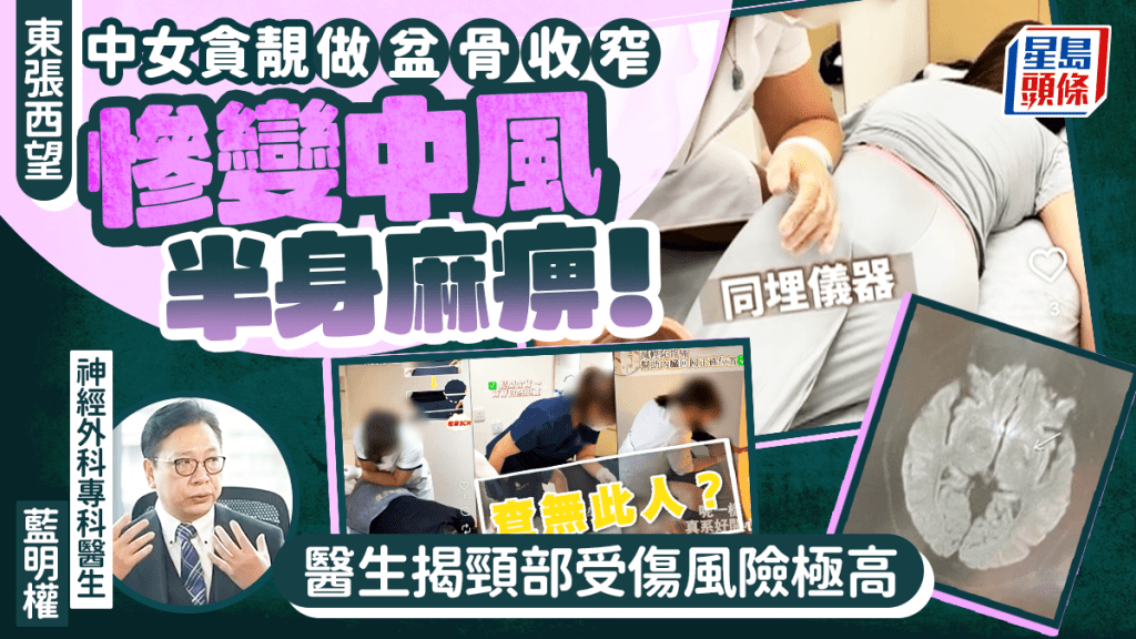 东张西望｜中女贪靓做盆骨收窄 惨变中风半身麻痹！医生拆解颈部受伤风险极高 