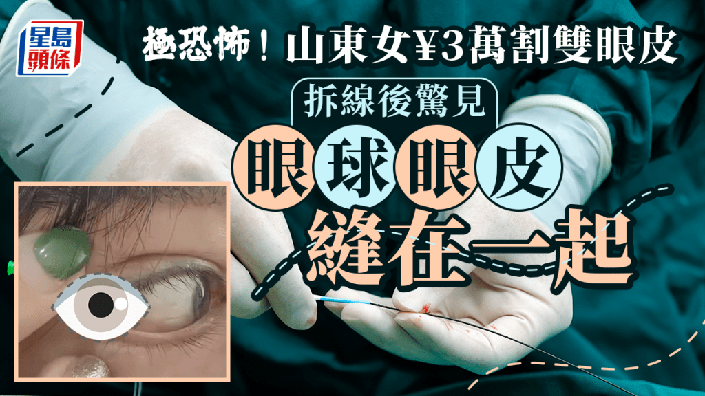 女子花3萬割雙眼皮，怎料拆線後「眼球和眼皮被縫在一起」，再開刀亦增生，眼球無法正常轉動。