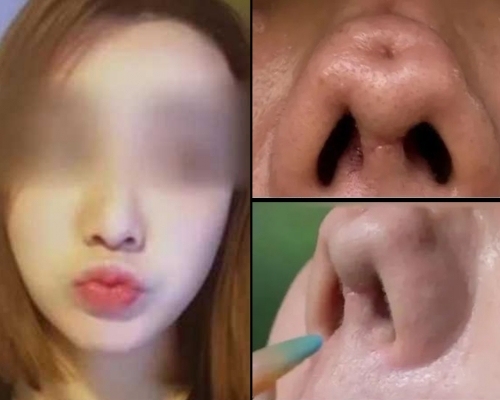 女主播花2萬多元做「隆鼻修復術」，竟把鼻子弄凹了，不敢見人。（網圖）