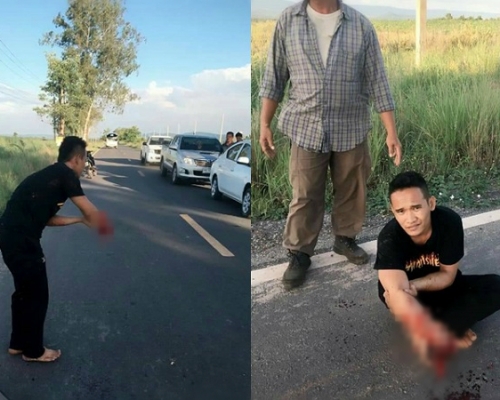 男子右手半截手臂被炸斷。網上圖片