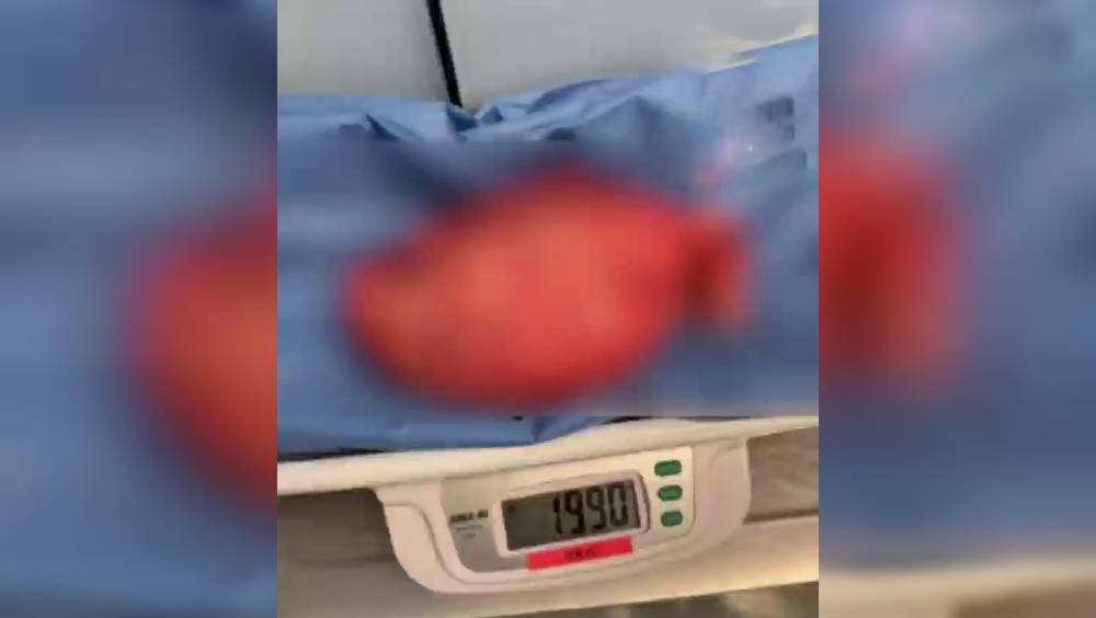 湖南16歲女孩肚大如懷胎八月，左腎查出2kg巨瘤，醫生成功「拆彈」。  第一現場