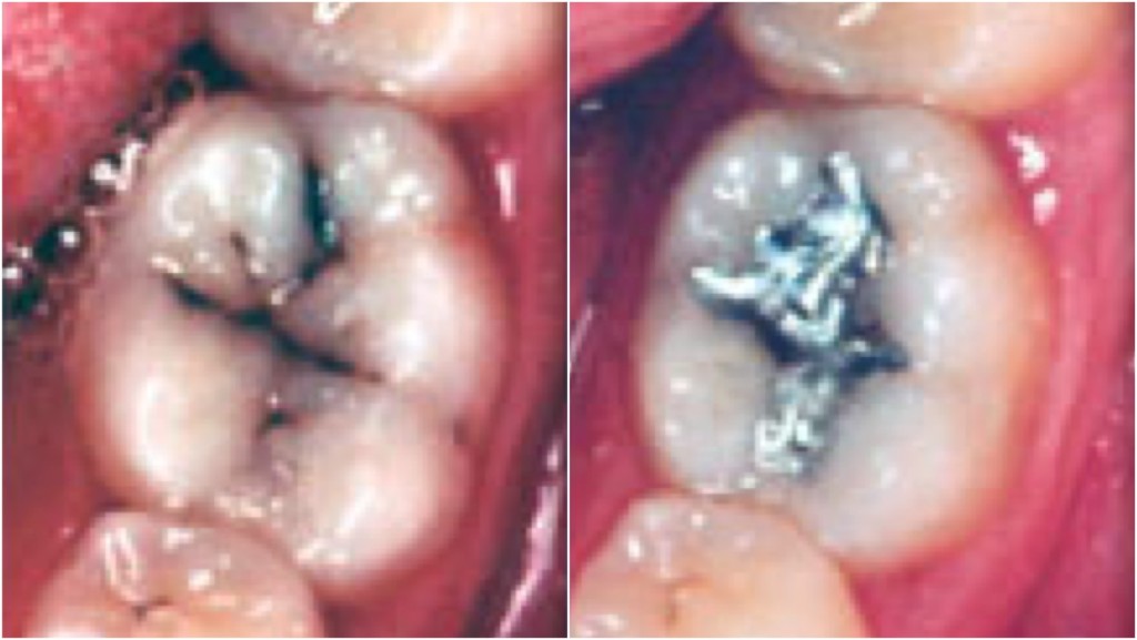 銀汞補牙2034年起禁用。左：蛀牙；右：補牙效果。  衛生署口腔健康促進科