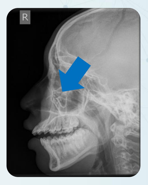有个案涉及鼻咽管器具被遗留在病人鼻后间隙。