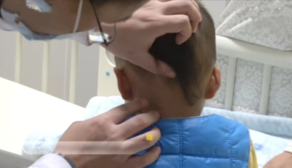 男童經手術後已經取出筷子。網上圖片