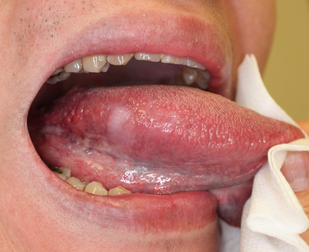 病人舌頭上出現良性的白斑久久未瘉，需要進一步檢查，提防癌變。