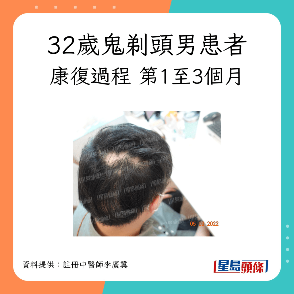 32歲脫髮（鬼剃頭）男患者康復過程，經中醫治療第1至3個月