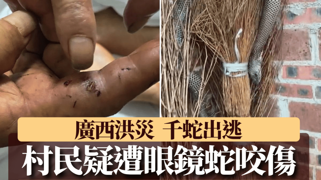 被毒蛇咬傷村民：在家清理垃圾時手指被咬。 極目新聞