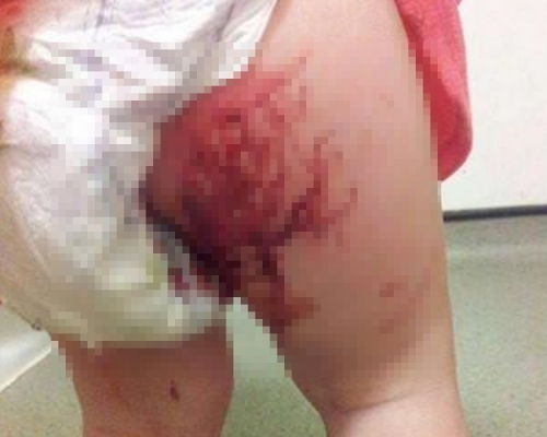 Amy當時看到女兒雙腿不斷流血。　網圖