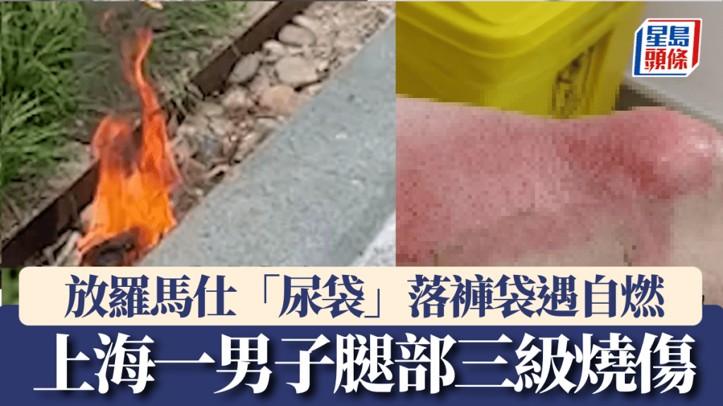 上海一男子放羅馬仕「尿袋」入褲袋，致腿部三級燒傷需植皮。